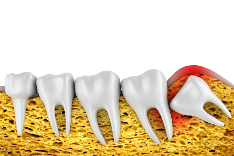 Cirugía de terceros molares